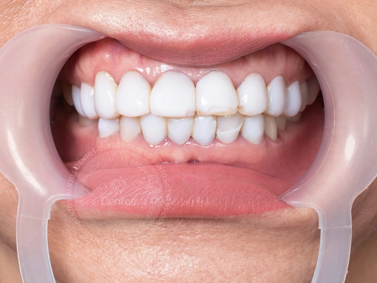 Răng phủ sứ nano nhanh chóng sứt mẻ, bong tróc chỉ sau thời gian ngắn sử dụng